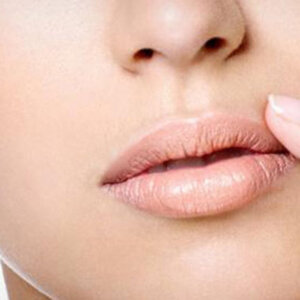 Solution-Clinic-Laser Hairremoval-Upper Lip-Woman