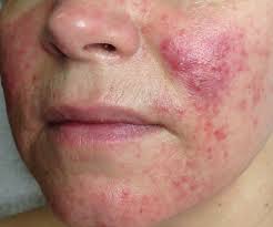 Rosacea