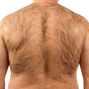 Solution-Clinic-Laser Hair removal-Back-Man