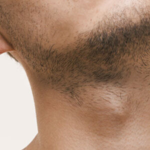 Solution-Clinic-Laser Hair removal-Neck-Neck-Man