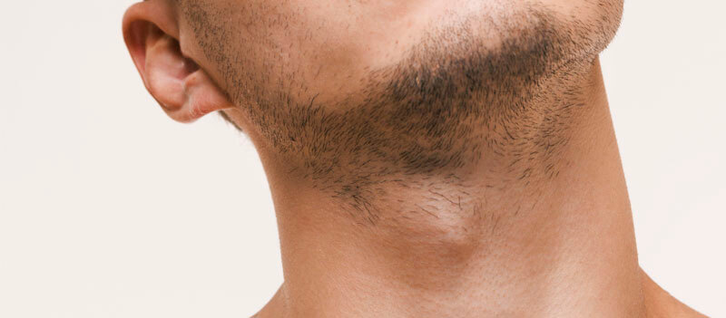 Neck hair removal | Laser hair removal | Solution Clinic