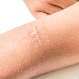 solution-clinic-litteken-therapie-laser