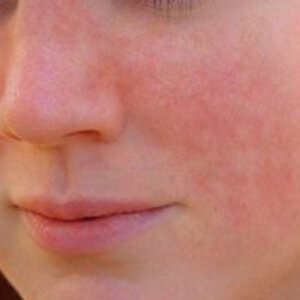 Diffuse redness