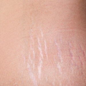 solution-clinic-laser-stretch marks