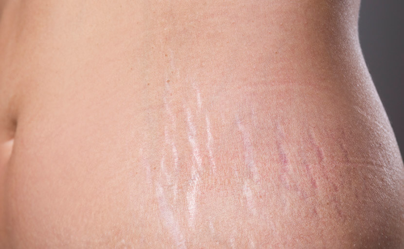 Spray tan on stretch marks pictures.