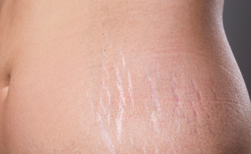 Stretch Marks Removal