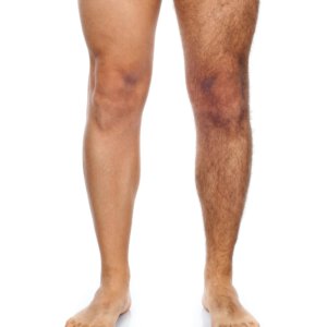 Solution-Clinic-Laser Hair removal-Legs-Man
